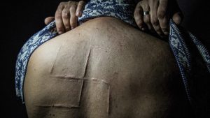 Bogdan was a civilian resident of Donetsk who was taken from his workplace by masked men after he wrote a post opposing the so-called referendum. He was held in the basement of an occupied SBU building, he spent 10 hours in captivity, tortured and beaten, and his captors removed two of his fingernails and engraved the swastika on his back. They referred to him as a “Nazi”. Due to the scar, they did not intend to let him go alive. His relatives managed to rescue him after 10 hours of torture. All images: Zoya Shu